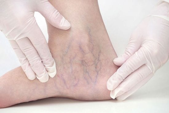 How to get rid of spider veins?